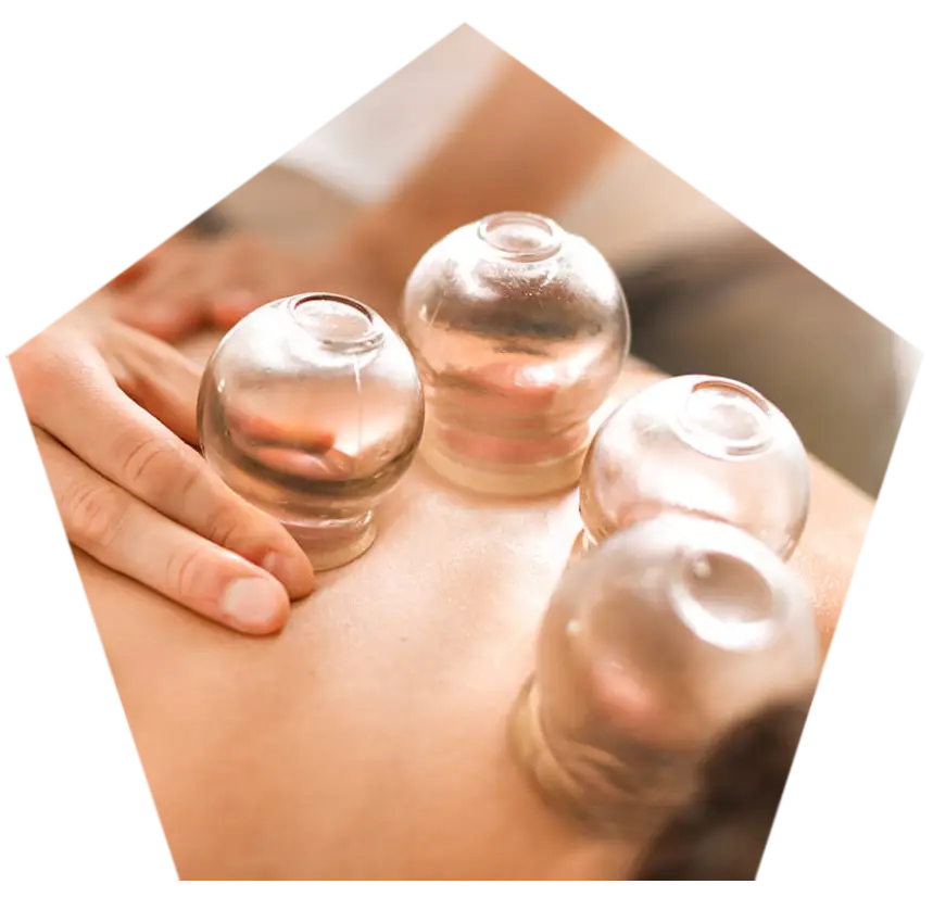 A patient receiving a therapeutic cupping treatment from a chiropractor.